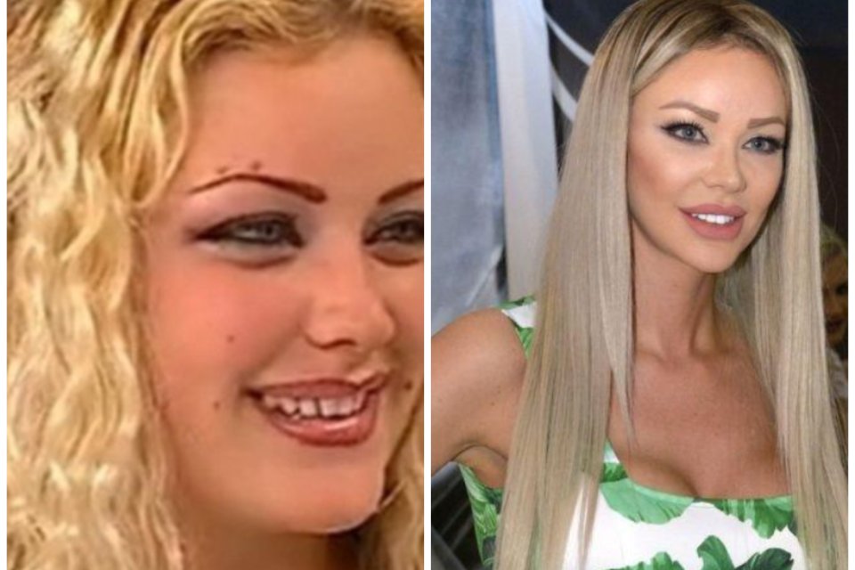 Bianca Drăguşanu, operaţie estetică de 11 ore! A paralizat pe partea dreaptă.